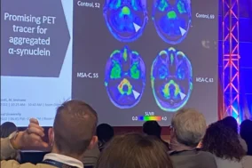 Images on a screen of pathological alpha-synuclein in the human brain