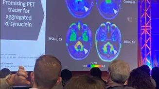 Images on a screen of pathological alpha-synuclein in the human brain